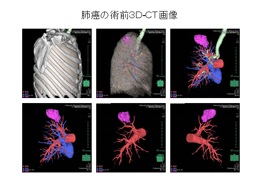 肺癌の術前3D-CT画像