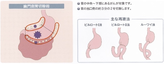 低位前方切除術