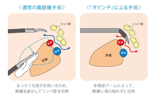 胃　ダビンチ手術.png