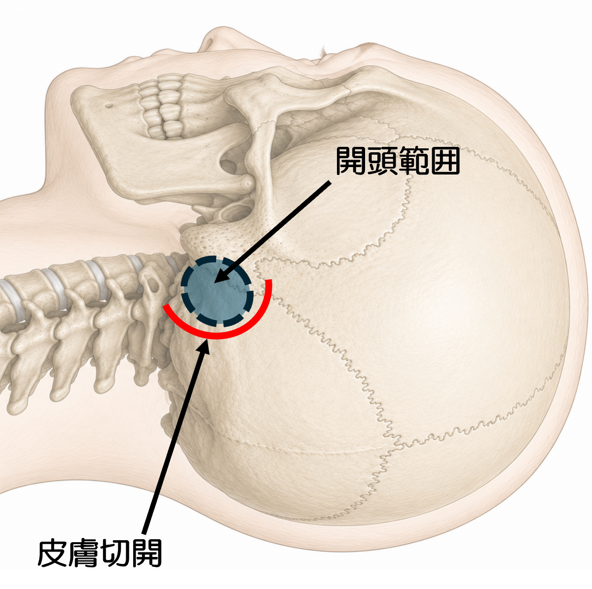 「さらくら46号」脳神経減圧術について(脳神経外科医)①.png